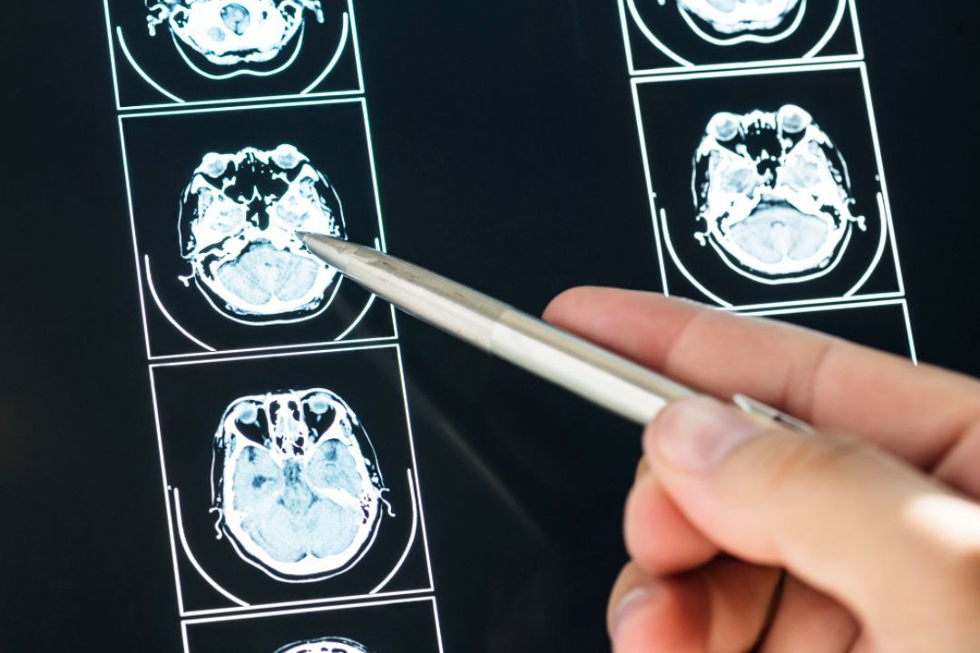 exploring the power of ct brain contrast in modern diagnostics